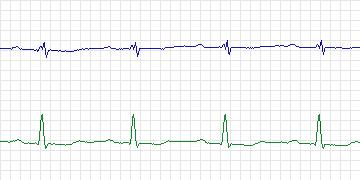 Electrocardiogram for European ST-T, record e0139