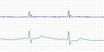 Electrocardiogram for European ST-T, record e0147