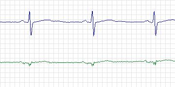 Electrocardiogram for European ST-T, record e0151
