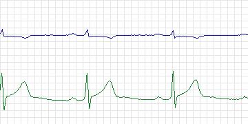 Electrocardiogram for European ST-T, record e0154