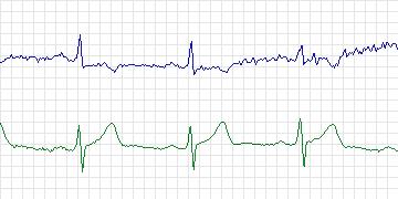 Electrocardiogram for European ST-T, record e0155