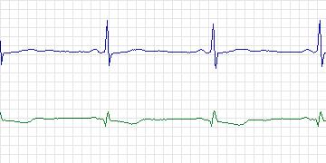Electrocardiogram for European ST-T, record e0161