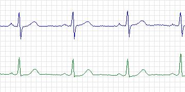 Electrocardiogram for European ST-T, record e0162