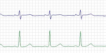 Electrocardiogram for European ST-T, record e0163