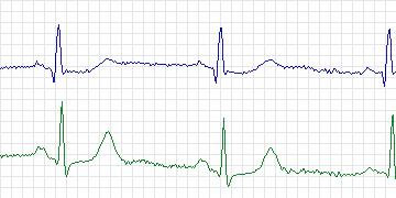 Electrocardiogram for European ST-T, record e0166