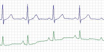 Electrocardiogram for European ST-T, record e0170
