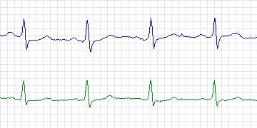 Electrocardiogram for European ST-T, record e0202