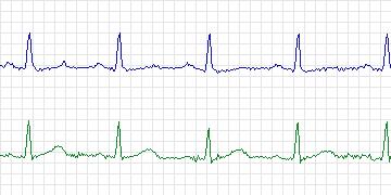 Electrocardiogram for European ST-T, record e0204