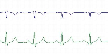 Electrocardiogram for European ST-T, record e0205