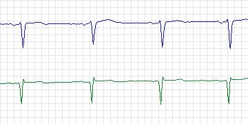 Electrocardiogram for European ST-T, record e0403