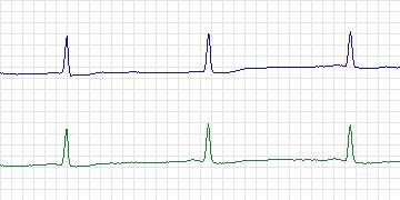 Electrocardiogram for European ST-T, record e0404