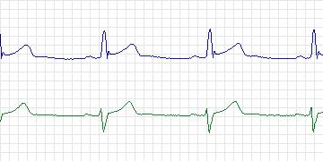 Electrocardiogram for European ST-T, record e0405