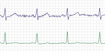 Electrocardiogram for European ST-T, record e0406