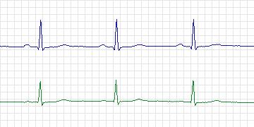 Electrocardiogram for European ST-T, record e0408