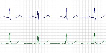 Electrocardiogram for European ST-T, record e0409
