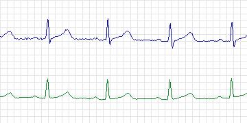 Electrocardiogram for European ST-T, record e0411