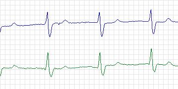 Electrocardiogram for European ST-T, record e0413