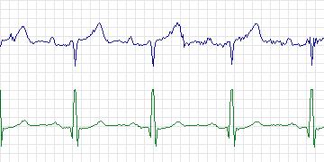 Electrocardiogram for European ST-T, record e0415