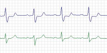 Electrocardiogram for European ST-T, record e0417