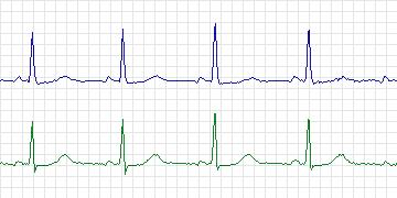Electrocardiogram for European ST-T, record e0418