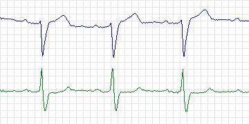 Electrocardiogram for European ST-T, record e0501