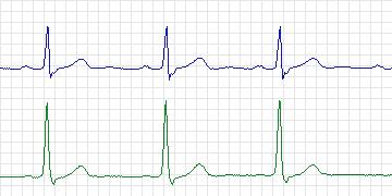Electrocardiogram for European ST-T, record e0509