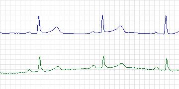 Electrocardiogram for European ST-T, record e0601