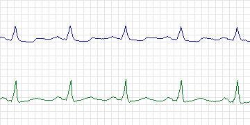 Electrocardiogram for European ST-T, record e0602