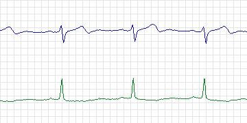 Electrocardiogram for European ST-T, record e0603