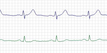 Electrocardiogram for European ST-T, record e0604