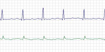 Electrocardiogram for European ST-T, record e0605