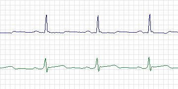 Electrocardiogram for European ST-T, record e0607