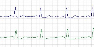 Electrocardiogram for European ST-T, record e0609