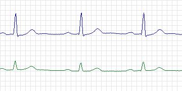 Electrocardiogram for European ST-T, record e0610
