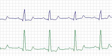 Electrocardiogram for European ST-T, record e0808