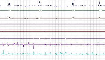 Electrocardiogram for Intracardiac Atrial Fibrillation, record iaf1_afw