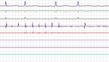 Electrocardiogram for Intracardiac Atrial Fibrillation, record iaf1_ivc