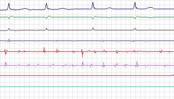 Electrocardiogram for Intracardiac Atrial Fibrillation, record iaf1_svc