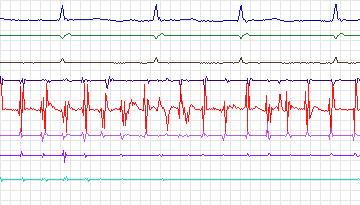 Electrocardiogram for Intracardiac Atrial Fibrillation, record iaf1_tva