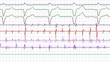 Electrocardiogram for Intracardiac Atrial Fibrillation, record iaf2_afw