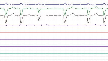 Electrocardiogram for Intracardiac Atrial Fibrillation, record iaf2_ivc