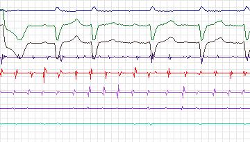 Electrocardiogram for Intracardiac Atrial Fibrillation, record iaf2_svc