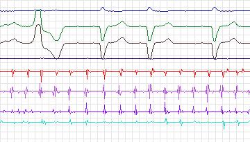 Electrocardiogram for Intracardiac Atrial Fibrillation, record iaf2_tva