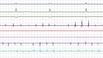 Electrocardiogram for Intracardiac Atrial Fibrillation, record iaf3_afw