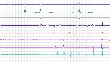 Electrocardiogram for Intracardiac Atrial Fibrillation, record iaf3_ivc