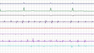 Electrocardiogram for Intracardiac Atrial Fibrillation, record iaf3_svc