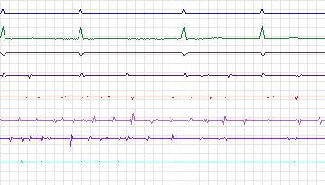 Electrocardiogram for Intracardiac Atrial Fibrillation, record iaf3_tva