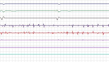 Electrocardiogram for Intracardiac Atrial Fibrillation, record iaf4_afw