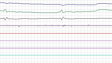 Electrocardiogram for Intracardiac Atrial Fibrillation, record iaf4_ivc