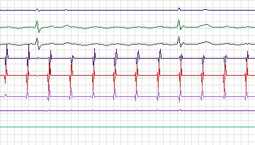 Electrocardiogram for Intracardiac Atrial Fibrillation, record iaf5_tva